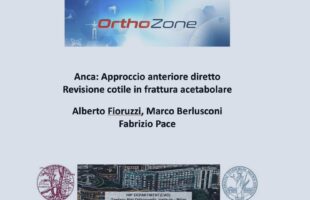Frattura Complessa di bacino – Revisione di coppa acetabolare