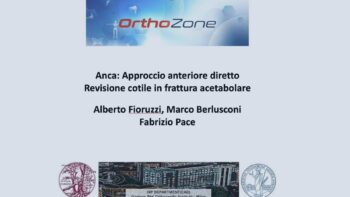 Frattura Complessa di bacino – Revisione di coppa acetabolare